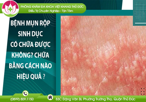 mụn rộp sinh dục có chữa được không